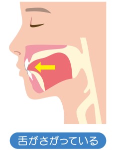 舌の位置　開咬