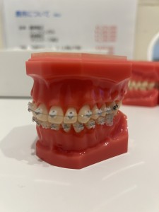 表側矯正の装置の模型
