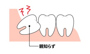 親知らず　抜歯　渋谷矯正歯科　
