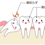 親知らず　抜歯　渋谷矯正歯科