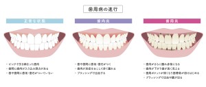 歯周病