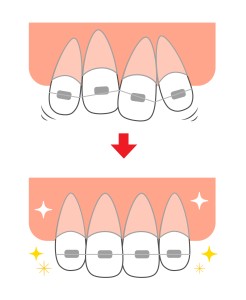 歯列矯正で歯が動くイメージイラスト