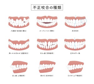 不正咬合の種類一覧