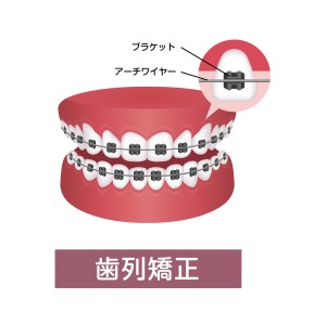 表側矯正の説明のイラスト