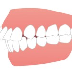 出っ歯の歯並びのイラスト