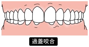 深い噛み合わせ（過蓋咬合）のイラスト