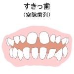 すきっ歯の歯並びのイラスト