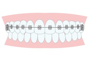 上の歯に矯正装置をつけているイラスト