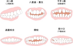 不正咬合の種類一覧のイラスト