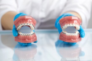ワイヤー矯正の模型を持つ手