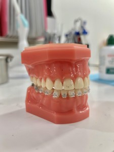 渋谷矯正歯科 ハーフリンガル矯正 ワイヤー矯正