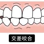 交叉咬合イラスト