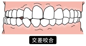交叉咬合イラスト