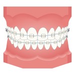 ホワイトワイヤー矯正のイラスト