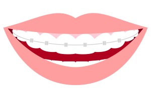 表側矯正のワイアーイラスト