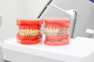 矯正装置模型のイメージ（2個）