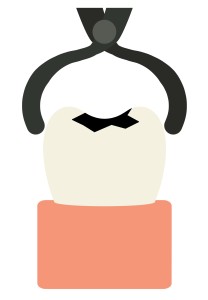 抜歯のイラスト