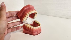 リンガル矯正の装置を片手で持つ状態