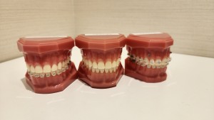 ３つの矯正装置模型