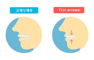 Tooth Contacting Habit（TCH）のイメージ