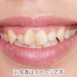 翼状捻転のイメージ