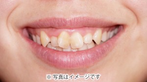翼状捻転のイメージ