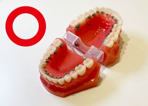 裏側矯正（舌側矯正）のメリットのイメージ