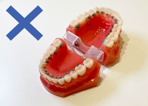 裏側矯正（舌側矯正）のデメリットのイメージ
