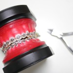 歯列矯正の装置の模型