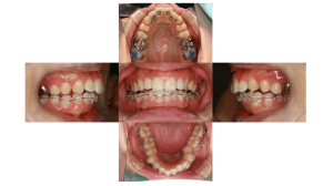 出っ歯・ハーフリンガル矯正の症例