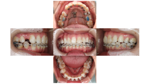 上顎前突・叢生・ハーフリンガルの症例