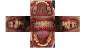 上顎前突・叢生・リンガルの症例