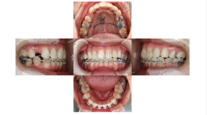 ハーフリンガル・上顎前突・1年後