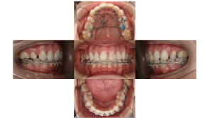 上顎前突・叢生・ハーフリンガルの症例