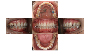 ハーフリンガル・上顎前突・2年