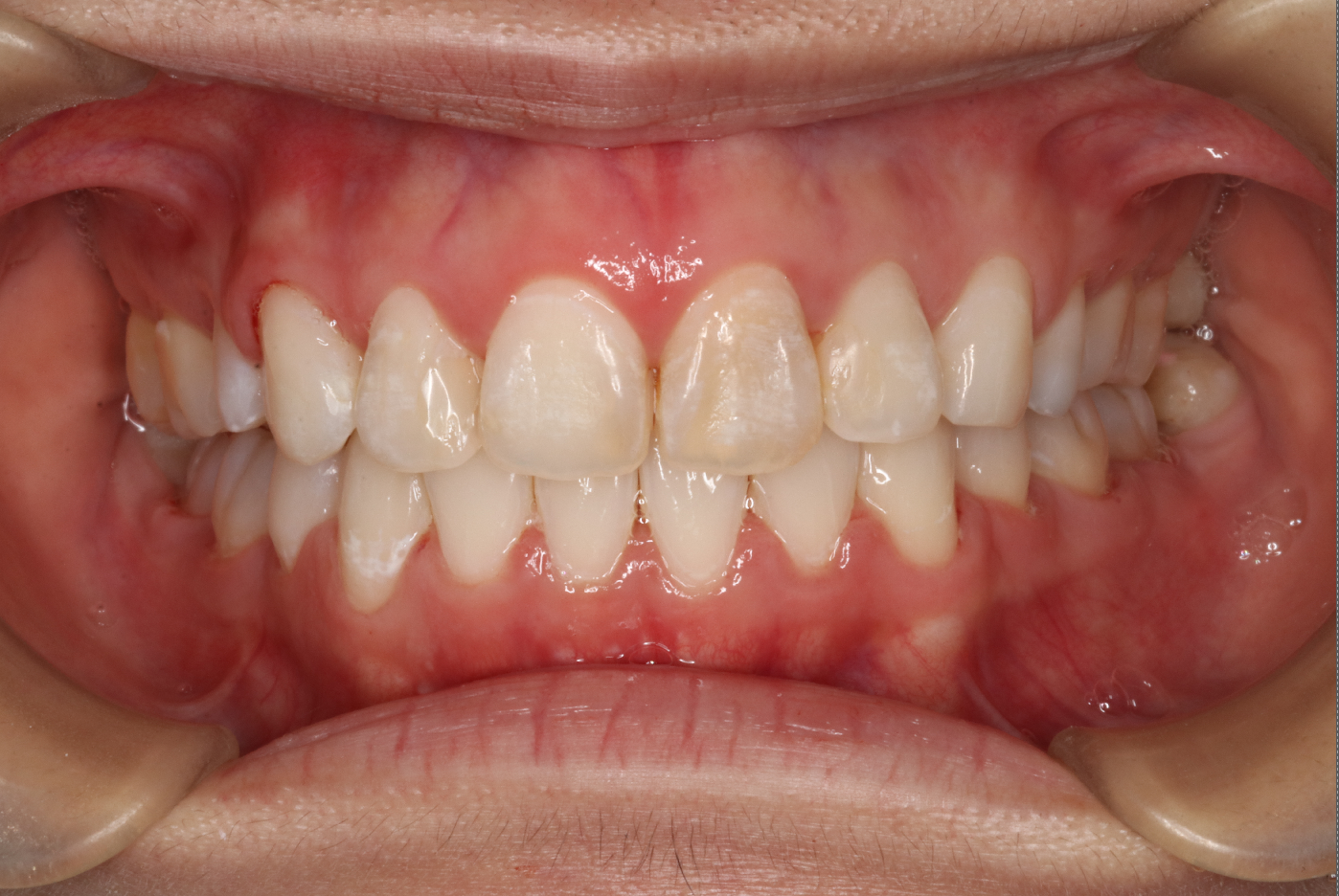 ハーフリンガル・上顎前突