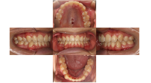 上顎前突・叢生・リンガルの症例