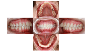 ハーフリンガル・上顎前突