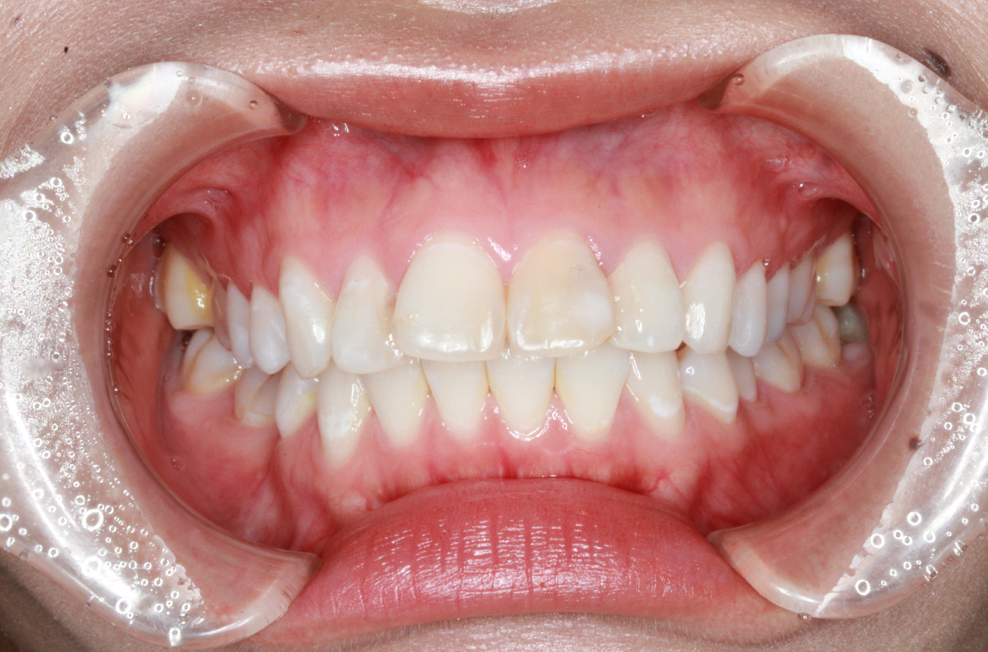 ハーフリンガル・上顎前突