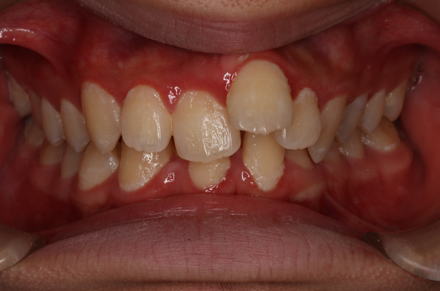 叢生・上顎前突・リンガルの症例