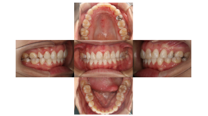 ハーフリンガル・上顎前突