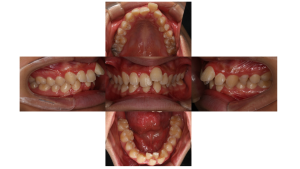 上顎前突・叢生・リンガルの症例