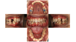 上顎前突・叢生・リンガルの症例