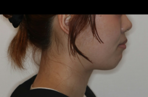 ハーフリンガル・上顎前突・横顔