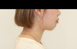 ハーフリンガル・上顎前突・横顔