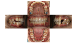 上顎前突・リンガルの症例