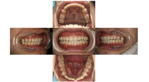 上顎前突・リンガルの症例