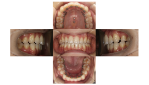 上顎前突・リンガルの症例