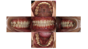 上顎前突・リンガルの症例