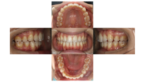 上顎前突・リンガルの症例